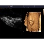 Spina bifida - Accuvix A30